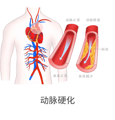 動(dòng)脈硬化檢測儀