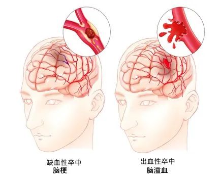 彩色經(jīng)顱多普勒超聲TCD：腦血管血流情況檢查